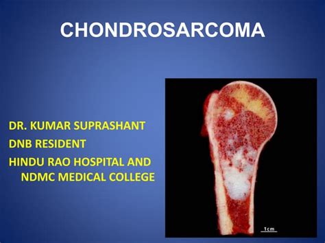 Chondrosarcoma