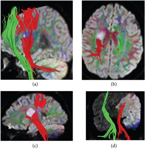 The Role of the Diffusion Tensor Imaging and the MR Tractography in the ...