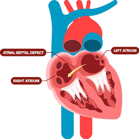 Encore Medical | Atrial Septal Defect (ASD) Closure Device