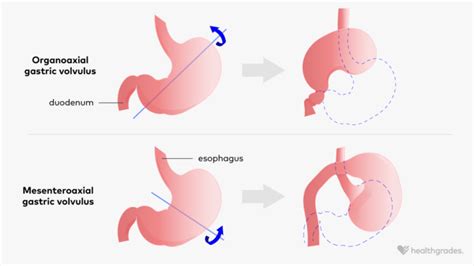 Volvulus: Definition, Causes, and Treatment