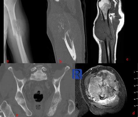 Bone metastasis