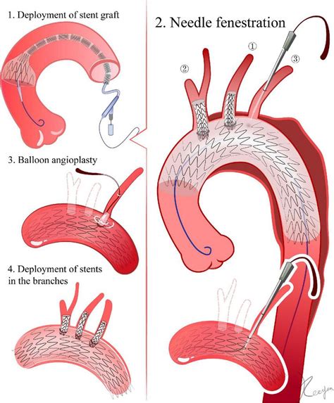 Needle fenestration. 1. Delivery of the stent graft. The ascending... | Download Scientific Diagram