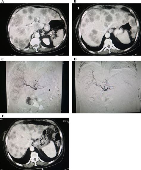 CT scans A diffuse lesions with 70% involvement unresected liver; B PD ...