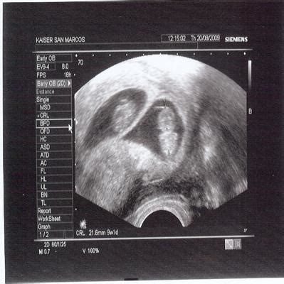 Identical Vs Fraternal Twins Ultrasound