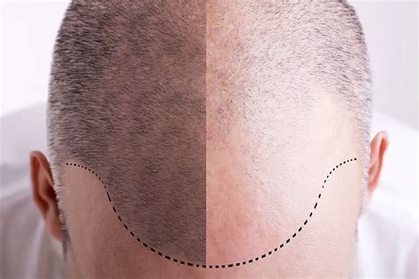 Definitive Guide to Hair Restoration: Types, Benefits, Costs - Bald & Beards