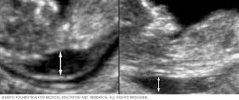 Nuchal translucency measurement - Mayo Clinic