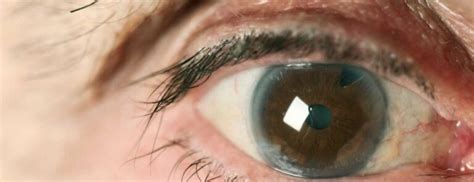 Blue Dot Cataract: Meaning, Symptoms, Causes And Treatment