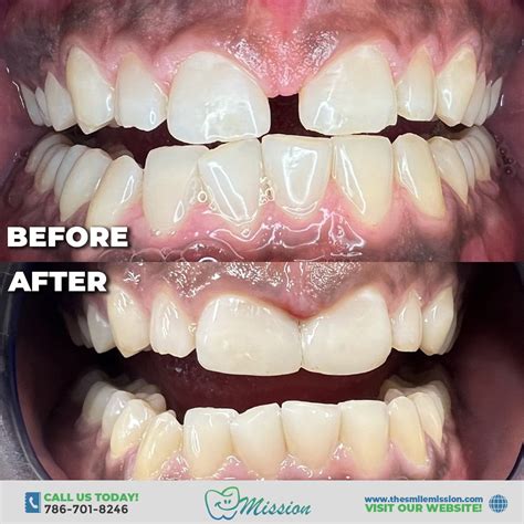 Composite Veneers - Dentist in Miami, FL | The Smile Mission