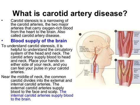 Internal Carotid Artery Stroke Symptoms