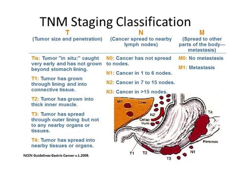 Gastric cancer - Cancer Therapy Advisor