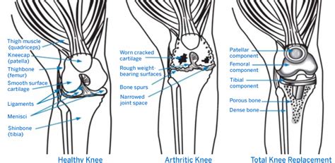 Anatomy Of Total Knee Replacement