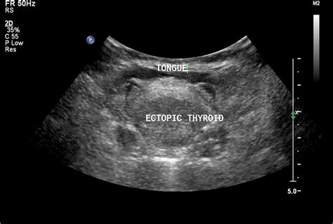 Lingual thyroid in a young female: role of imaging | BMJ Case Reports