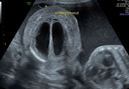 Fetal Hydrocephalus Ultrasound