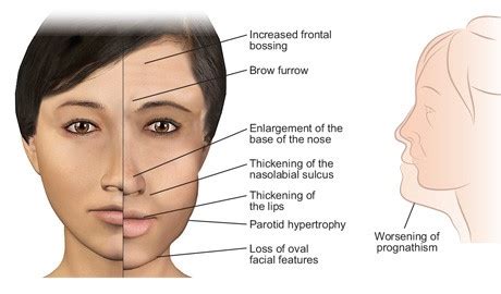 Acromegaly | RMI