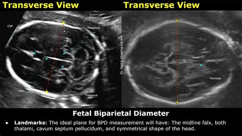 How To Measure Fetal Biparietal Diameter On Ultrasound | BPD Measurements | Biometric Parameters ...