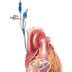 Cardioplegia Types, Mechanism, Antegrade, Retrograde Cardioplegia - Health Care Tips and Natural ...