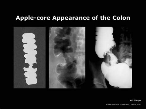 Apple Core Sign: Constriction of the Colon