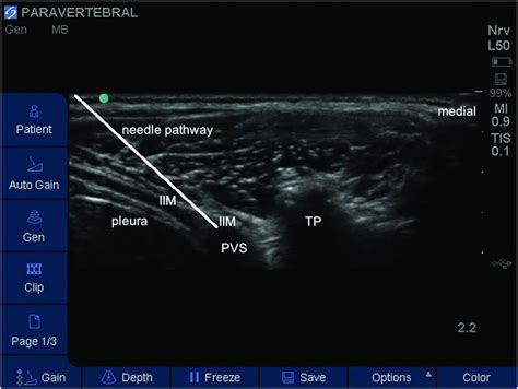 Ultrasound-guided paravertebral block | Anesthesia Key