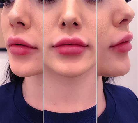 Pin on Fillers