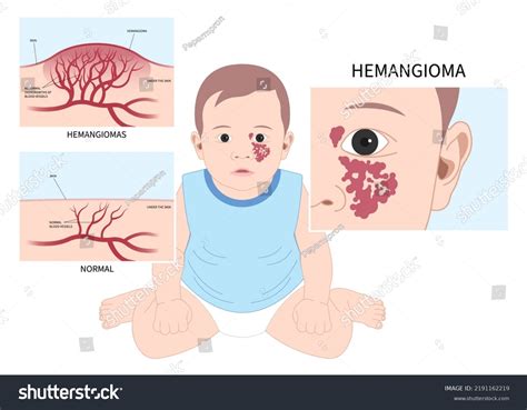 Weber Syndrome Symptoms