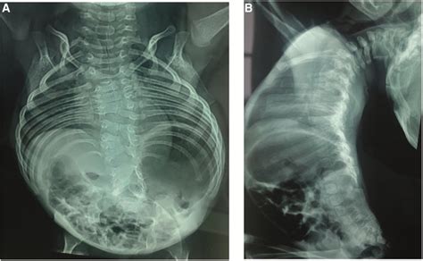 Frontiers | Case report: Exome sequencing revealed disease-causing variants in a patient with ...