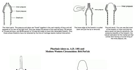 Saving Our Sons: Types of Circumcision: Brit Milah in Antiquity vs ...