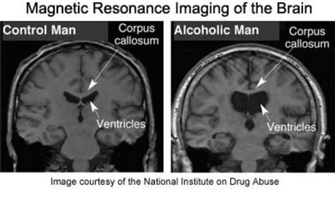 Alcoholic Dementia