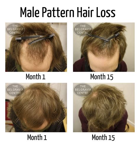 Biotin Hair Growth: Biotin Hair Growth In Men