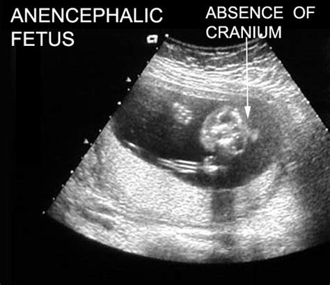 The Truth Behind Anencephaly | SiOWfa16: Science in Our World: Certainty and Controversy