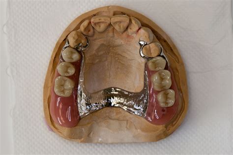 Dentures – Ryde Dental Practice