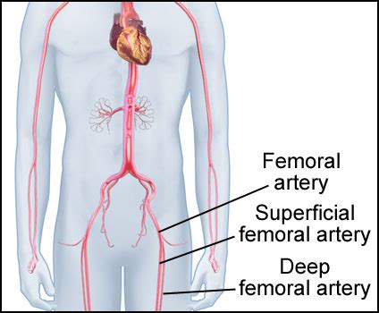 Femoral Artery Stent