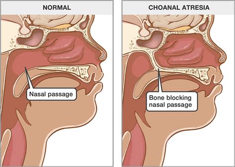 Choanal atresia causes, symptoms, diagnosis & treatment