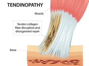 Tendinopathy Vs Tendonitis