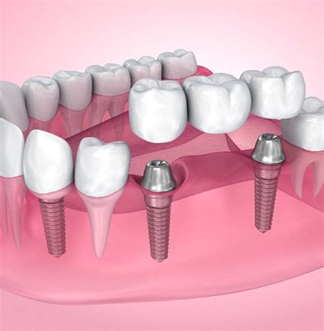 Implant-Retained Bridge Kansas City | Dental Implants | Dr. Michael Byars