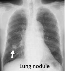 Abnormal Chest X-ray | What It Means For You | Chestmed