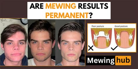 Are mewing results permanent? – Mewinghub