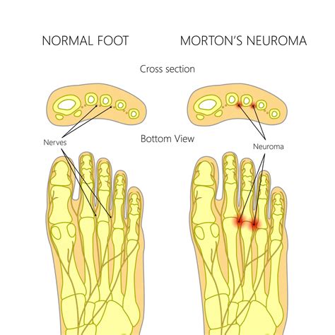 Pinched Nerve in Foot: the causes explained by a Foot Specialist