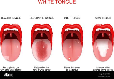 Ulcer Under Tongue