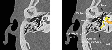 CT Anatomy of Ear | enteducationswansea