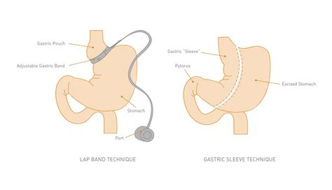 Lap Band Surgery - How It Works? - Weight Loss Surgery