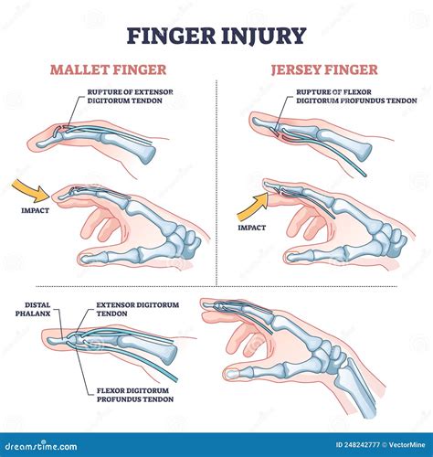 Finger Injury Types with Common Hand Impact Trauma Anatomy Outline ...