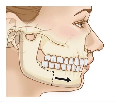 Schematic Illustration Of Mandibular Ramus Sagittal Split Osteotomy ...