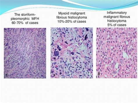 Malignant fibrous histiocytoma, Undifferntiated pleomorphic sarcoma