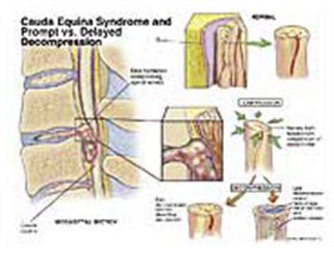 Cauda Equina Syndrome & Prompt vs. Delayed Decompression Medivisuals