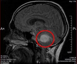 MRI scans to predict patients' ability to fight cancer