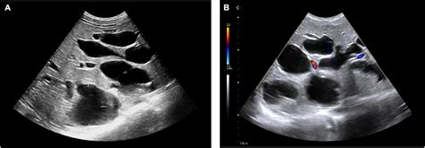 Frontiers | Childhood-onset Caroli’s disease as a cause of recurrent ...