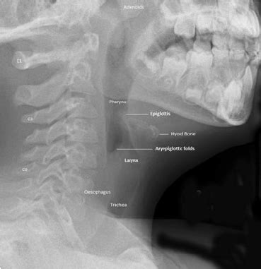 Normal lateral soft tissue radiograph of the neck (in a paediatric ...