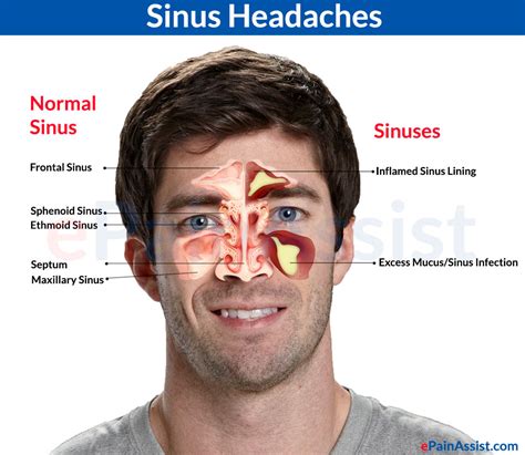 Mengenal Gejala Awal Sinusitis dan Cara Mencegahnya - Ahlinya Pengobatan