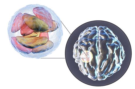 Brain Abscess Caused By Toxoplasma Gondii Photograph by Kateryna Kon/science Photo Library ...