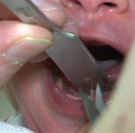 Frenotomy for tongue‐tie (frenulum linguae breve) showed improved ...